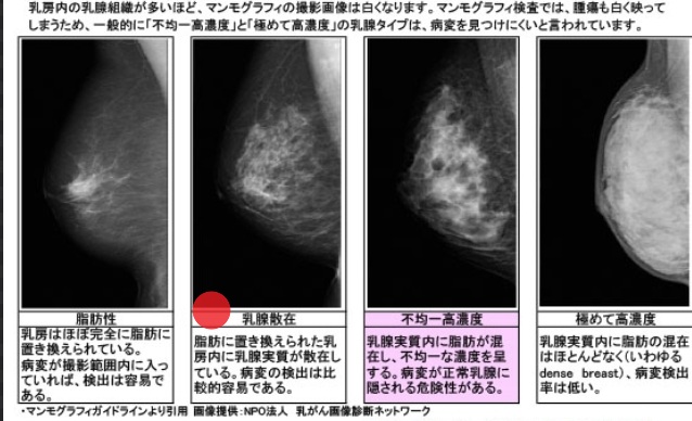 乳腺科結果の見方・乳腺タイプについて